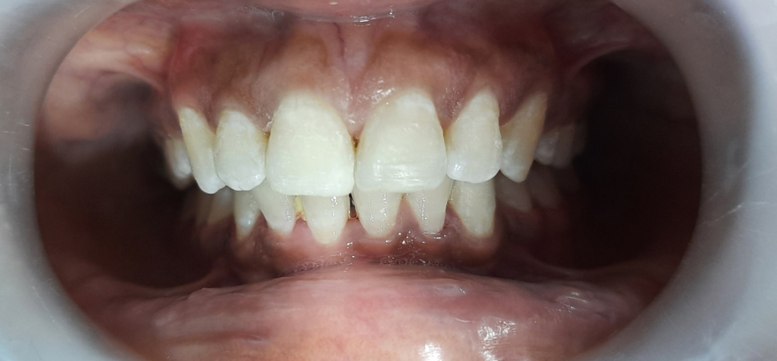 Invisible braces case 1 after treatment in Hyderabad