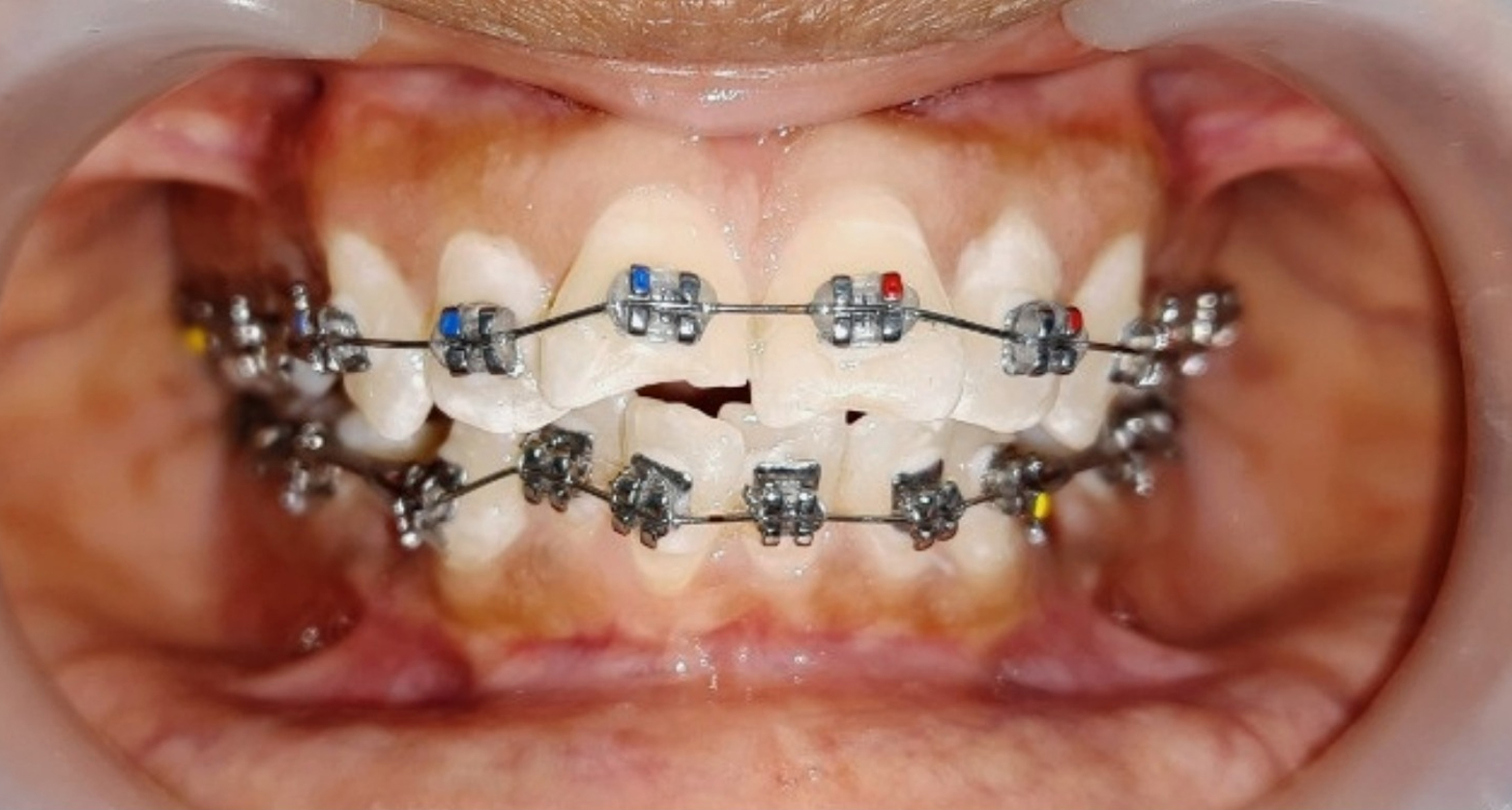 Invisible braces case 1 before treatment in Hyderabad
