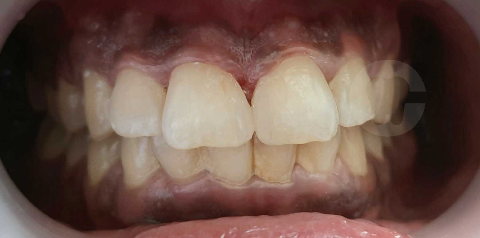 Invisalign case 2 after in Madinaguda