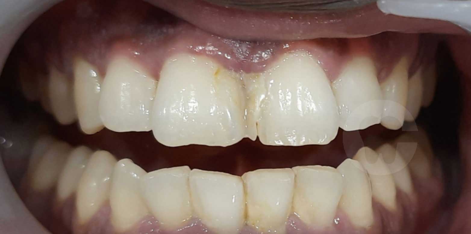 Invisalign case 2 before in Madinaguda